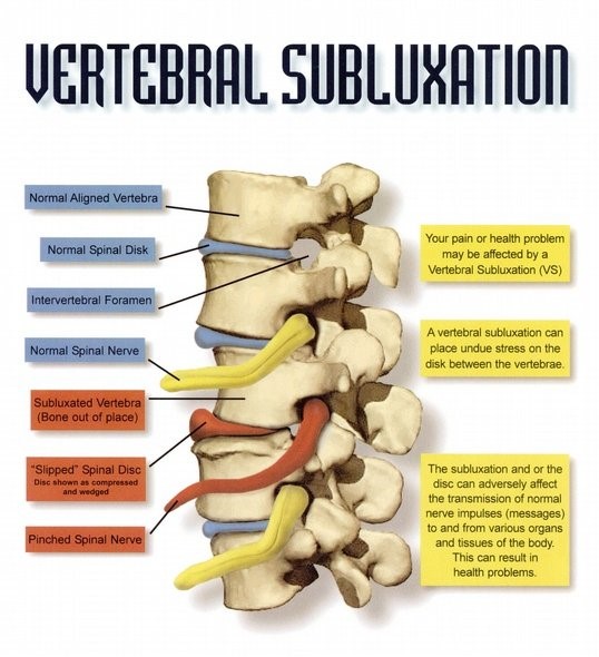Chiropractic Care - Vertebral Subluxation - Novato Chiropractic