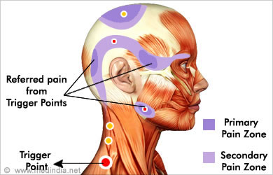 Trigger Point Therapy diagram used by Novato Chiropractor James Whittlesey DC